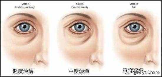 醒醒吧：什么眼霜都救不了黑眼圈！6款眼霜分析：这2款又贵又没用