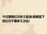 今日更新红印多久能消(疤痕留下的红印子要多久淡化)