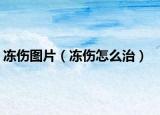 冻伤图片（冻伤怎么治）