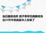 当日最新消息 男子患罕见病肺部洗出17升牛奶画面令人惊呆了