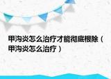 甲沟炎怎么治疗才能彻底根除（甲沟炎怎么治疗）