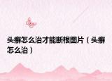 头癣怎么治才能断根图片（头癣怎么治）