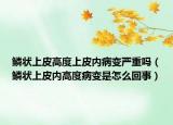 鳞状上皮高度上皮内病变严重吗（鳞状上皮内高度病变是怎么回事）
