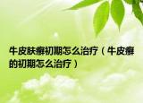 牛皮肤癣初期怎么治疗（牛皮癣的初期怎么治疗）