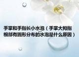 手掌和手指长小水泡（手掌大拇指根部有圆形分布的水泡是什么原因）