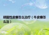 顽固性皮癣怎么治疗（牛皮癣怎么治）