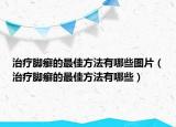 治疗脚癣的最佳方法有哪些图片（治疗脚癣的最佳方法有哪些）