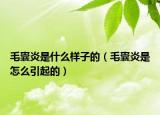 毛囊炎是什么样子的（毛囊炎是怎么引起的）