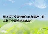 腿上长了个硬疙瘩怎么办图片（腿上长了个硬疙瘩怎么办）