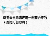 斑秃会自愈吗还是一定要治疗的（斑秃可自愈吗）