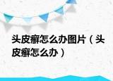 头皮癣怎么办图片（头皮癣怎么办）