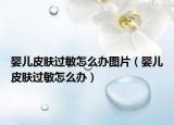 婴儿皮肤过敏怎么办图片（婴儿皮肤过敏怎么办）