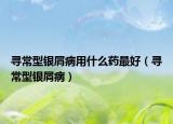 寻常型银屑病用什么药最好（寻常型银屑病）