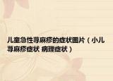 儿童急性荨麻疹的症状图片（小儿荨麻疹症状 病理症状）
