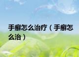 手癣怎么治疗（手癣怎么治）