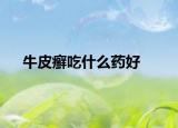 牛皮癣吃什么药好