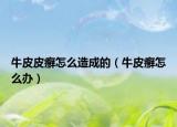 牛皮皮癣怎么造成的（牛皮癣怎么办）