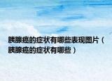 胰腺癌的症状有哪些表现图片（胰腺癌的症状有哪些）