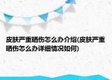 皮肤严重晒伤怎么办介绍(皮肤严重晒伤怎么办详细情况如何)