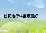 如何治疗牛皮癣最好