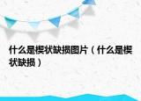 什么是楔状缺损图片（什么是楔状缺损）