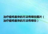治疗痤疮最快的方法有哪些图片（治疗痤疮最快的方法有哪些）