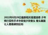 2022年8月29日最新相关报道消息 少年骑行受伤手术中发现少块骨头 骨头画面让人看着感到后怕