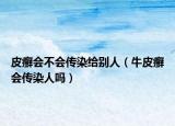 皮癣会不会传染给别人（牛皮癣会传染人吗）