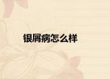 银屑病怎么样