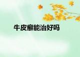 牛皮癣能治好吗
