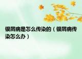 银屑病是怎么传染的（银屑病传染怎么办）