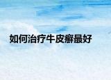 如何治疗牛皮癣最好