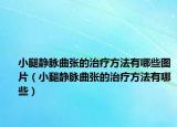 小腿静脉曲张的治疗方法有哪些图片（小腿静脉曲张的治疗方法有哪些）
