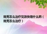 斑秃怎么治疗见效快用什么药（斑秃怎么治疗）