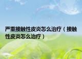 严重接触性皮炎怎么治疗（接触性皮炎怎么治疗）