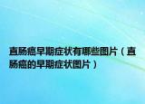 直肠癌早期症状有哪些图片（直肠癌的早期症状图片）