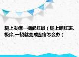 腿上发痒一挠起红斑（腿上暗红斑,极痒,一挠就变成疙瘩怎么办）