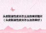 头皮脂溢性皮炎怎么治效果好图片（头皮脂溢性皮炎怎么治效果好）
