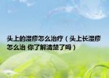 头上的湿疹怎么治疗（头上长湿疹怎么治 你了解清楚了吗）