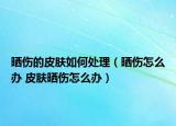 晒伤的皮肤如何处理（晒伤怎么办 皮肤晒伤怎么办）
