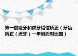 第一前磨牙和虎牙错位矫正（牙齿矫正（虎牙）一年侧面对比图）