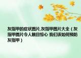 灰指甲的症状图片,灰指甲图片大全（灰指甲图片令人触目惊心 我们该如何预防灰指甲）