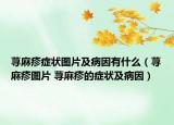 荨麻疹症状图片及病因有什么（荨麻疹图片 荨麻疹的症状及病因）
