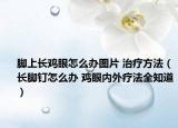 脚上长鸡眼怎么办图片 治疗方法（长脚钉怎么办 鸡眼内外疗法全知道）