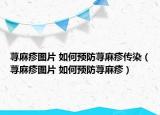 荨麻疹图片 如何预防荨麻疹传染（荨麻疹图片 如何预防荨麻疹）
