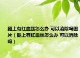 腿上有红血丝怎么办 可以消除吗图片（腿上有红血丝怎么办 可以消除吗）