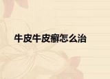牛皮牛皮癣怎么治