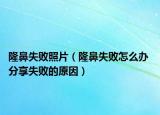 隆鼻失败照片（隆鼻失败怎么办 分享失败的原因）