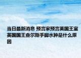 当日最新消息 预言家预言英国王室 英国国王查尔斯手脚水肿是什么原因