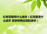 红斑苍狼有什么症状（红班狼苍什么症状 皮肤疾病出现的症状）